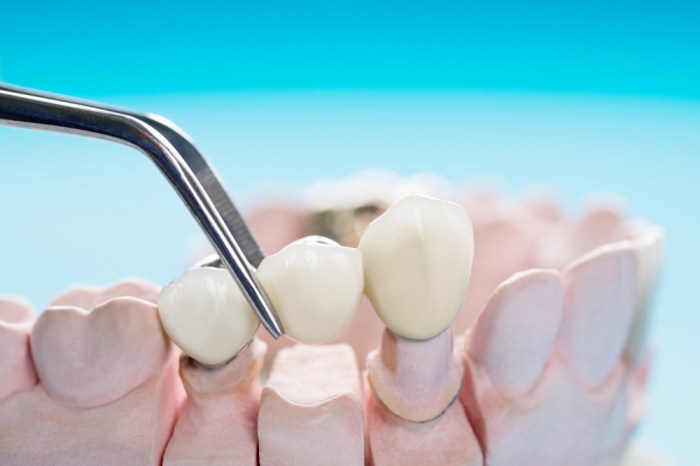 Fixed prosthodontics is commonly referred to as