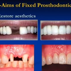 Prosthodontics fixed bridge dental