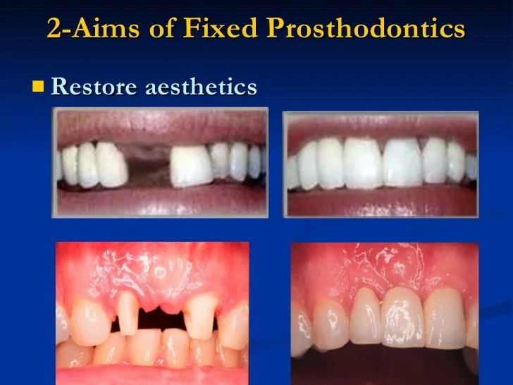 Prosthodontics fixed bridge dental